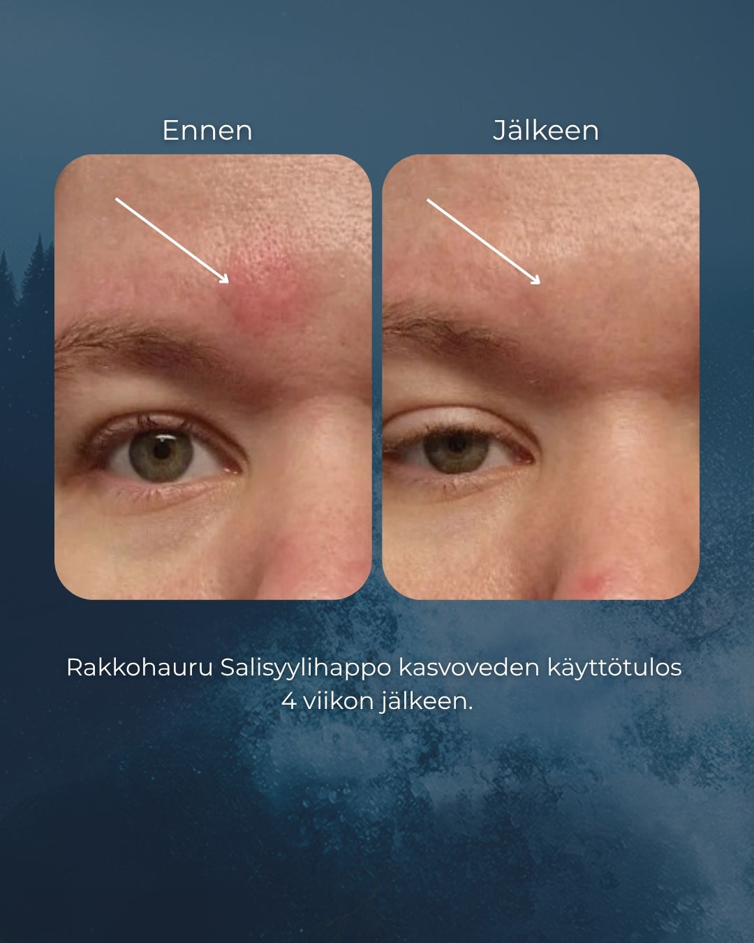 Rakkohauru Salisyylihappo kasvovesi, epäpuhtaalle ja herkästi rasvoittuvalle iholle