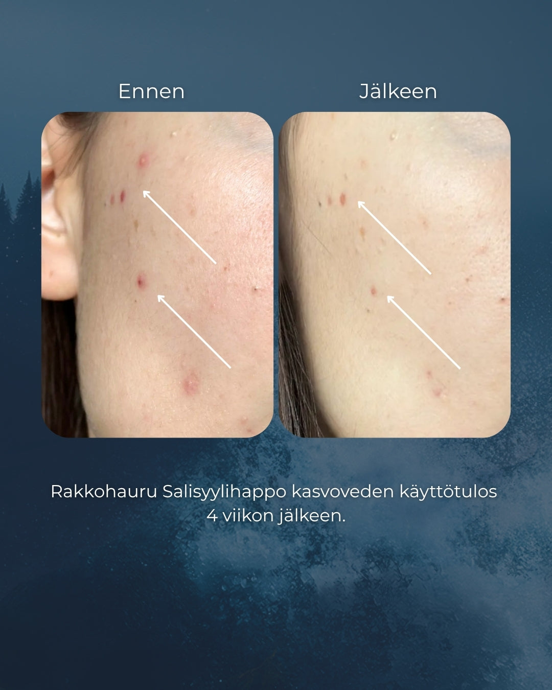 Rakkohauru Salisyylihappo kasvovesi, epäpuhtaalle ja herkästi rasvoittuvalle iholle